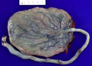Chorioamnionitis
