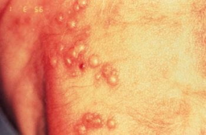 Congenital HSV vesicles