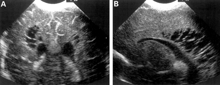 Cystic periventricular leukomalacia