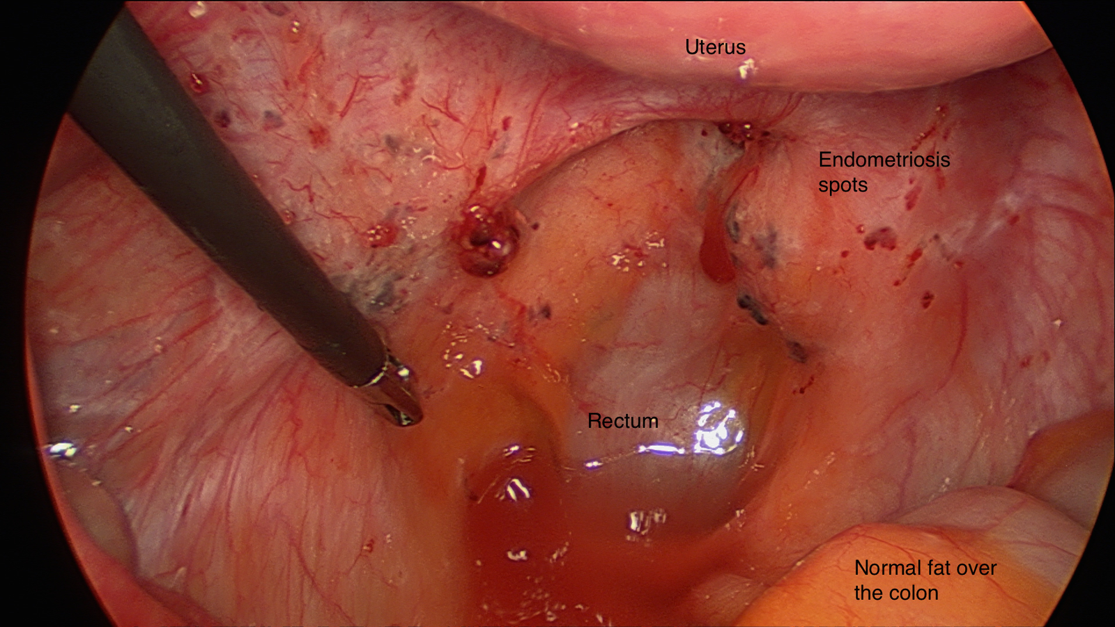 Diagnostic laparoscopy showing endometriosis