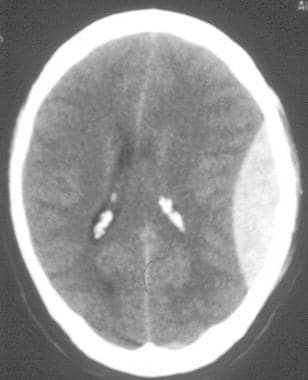 Epidural Hematoma