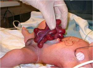 Gastroschisis
