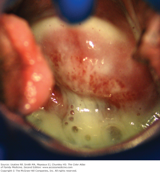 Greenish, frothy discharge of trichomoniasis with “strawberry”cervix