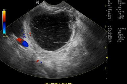 Hemorrhagic ovarian cyst on colour doppler