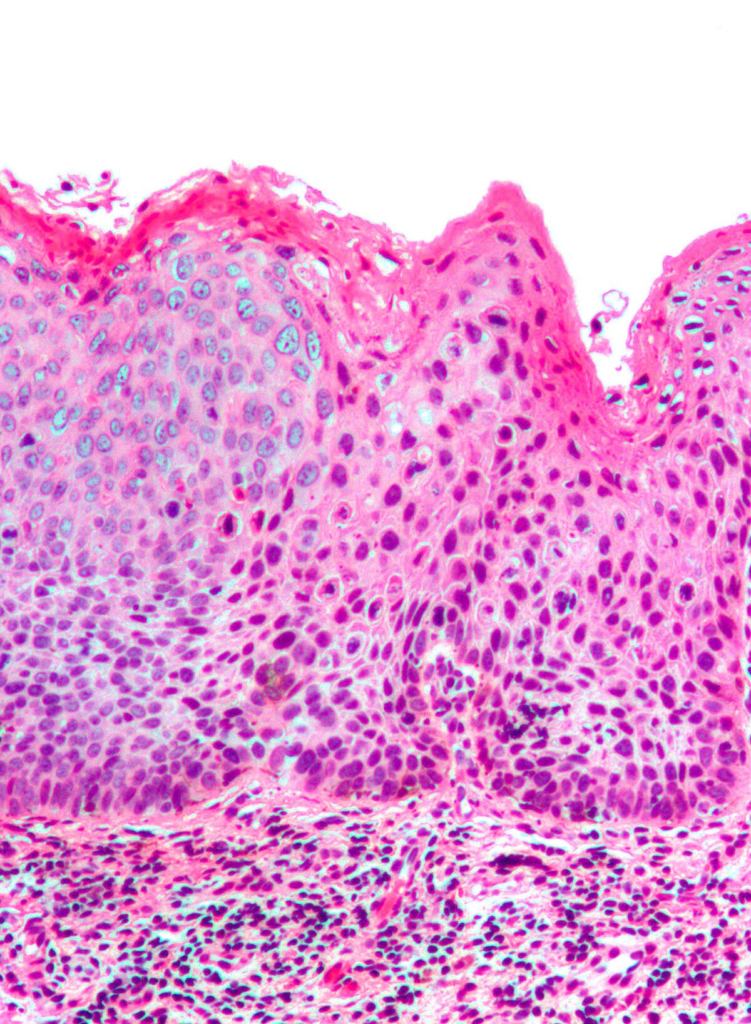 Histology showing vulvar intraepithelal neoplasia with halo cells