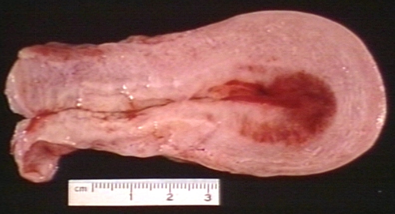 Normal uterus