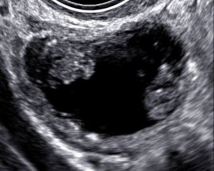 Ovarian tumor on ultrasound