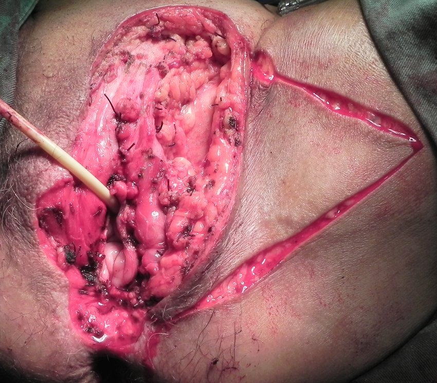 Radical vulvectomy with 2cm margins