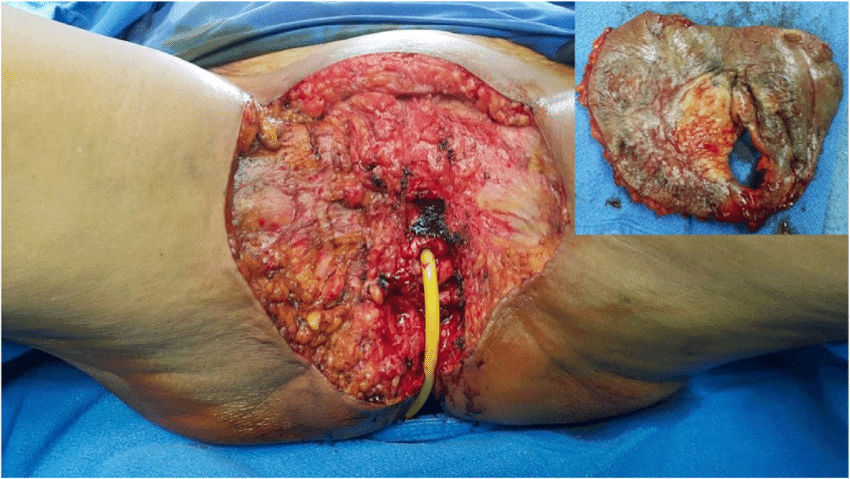 Radical vulvectomy with catheter in situ