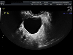 Simple ovarian cyst on ultrasound