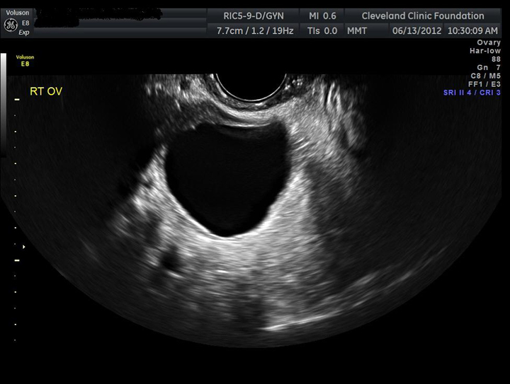 Simple ovarian cyst on ultrasound