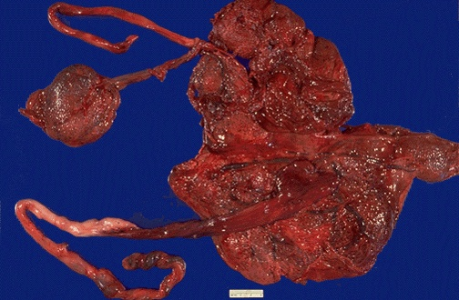 Succenturaite placenta