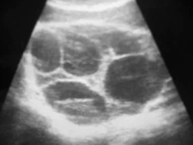 Theca lutein cyst on ultrasound