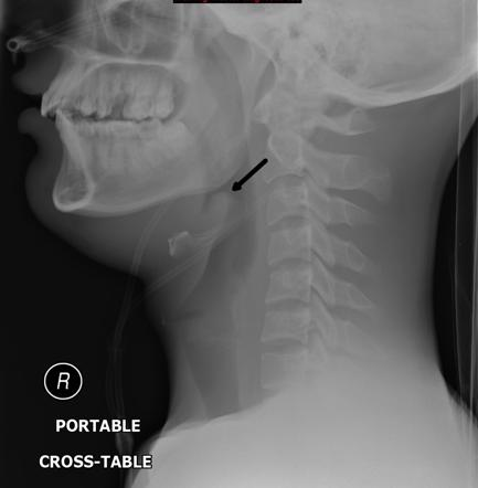 Thumb sign on lateral neck X-ray