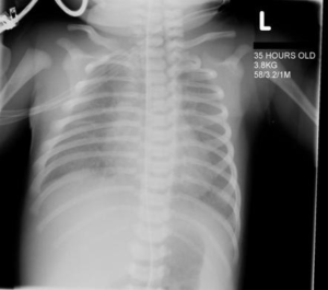 Transient Tachypnea of the Newborn