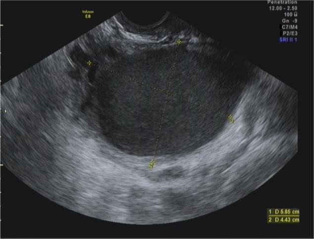 Endometriosis – Hyperexcision