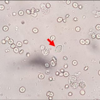 Trichomonad on saline prep