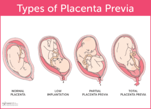 Antepartum Hemorrhage – Hyperexcision