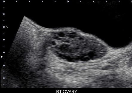 Ultrasound showing a polycystic ovary - chain of pearls appearance