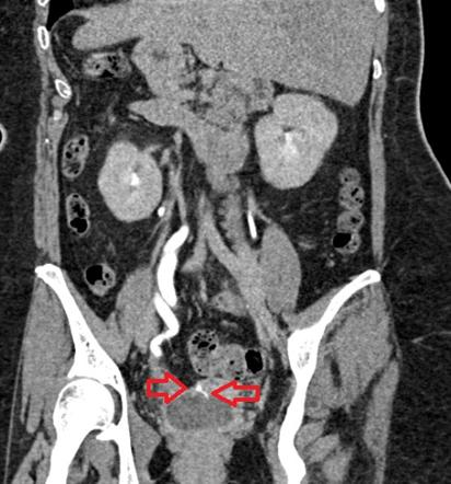 Ureterovaginal fistula on CT