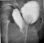 Urography showing vesicovaginal fistula