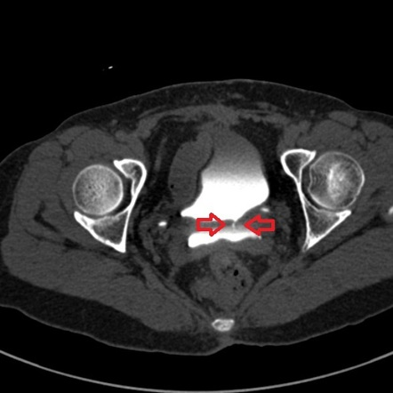 Vesicovaginal fistula on CT