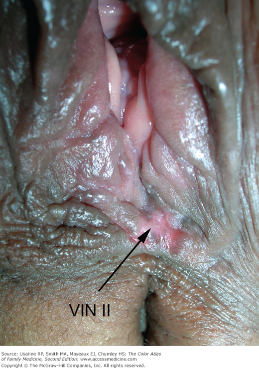 Vulvar intraepithelial neoplasia - VIN II
