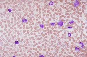 Blood film showing numerous granulocytic forms, including band cells and immature myeloid cells