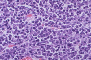 Bone marrow biopsy showing numerous plasma cells