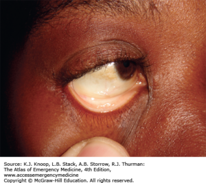 Conjunctival pallor