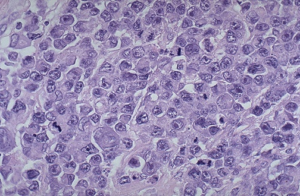 Diffuse Large B-cell lymphoma