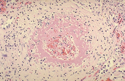 Fibrinoid necrosis