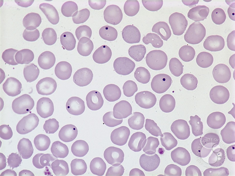 Howel-jolly bodies
