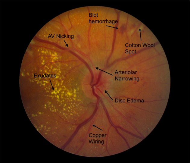 Hypertensive retinopathy