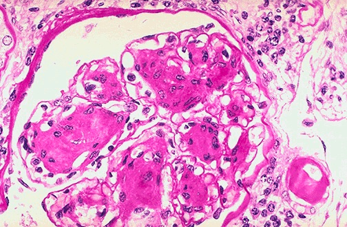 Lower right shows hyaline arteriosclerosis of a glomerular arteriole