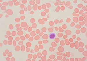 Macro-ovalocytes