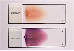 Peripheral blood smear