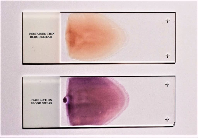 Peripheral blood smear