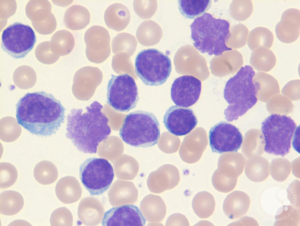 Smudge cells
