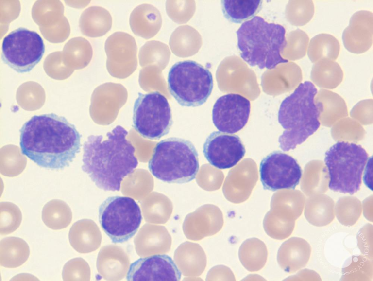 Smudge cells