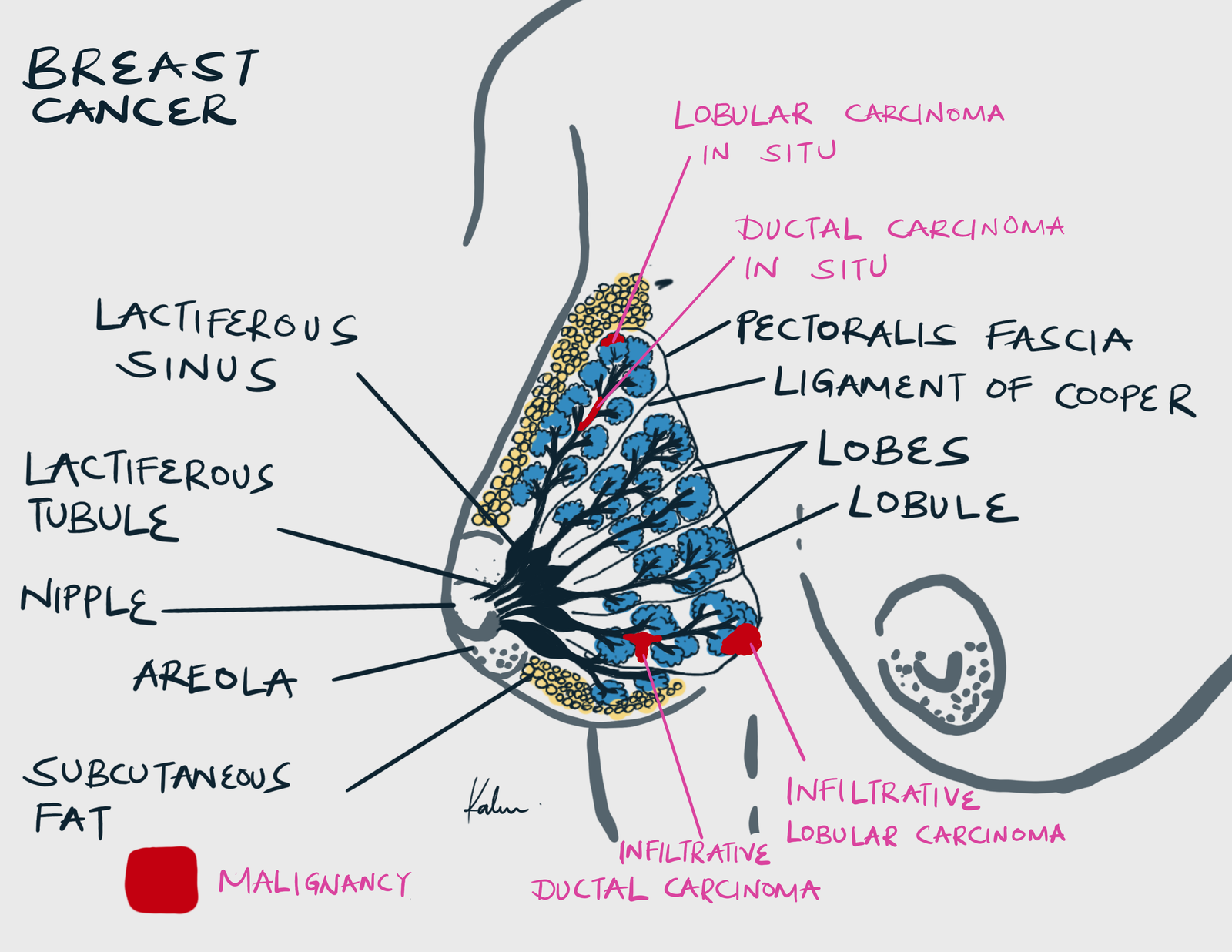 Breast cancer image
