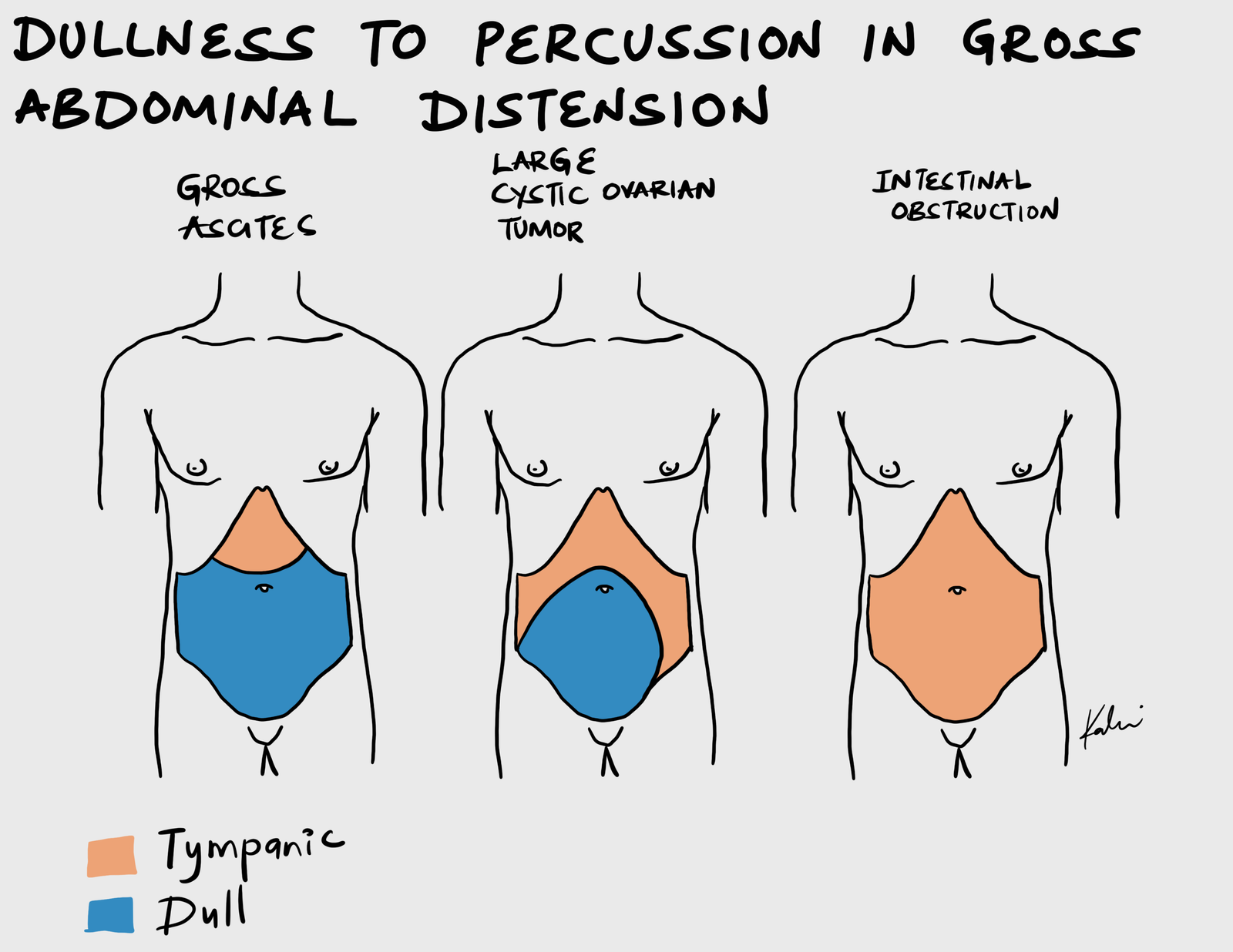Dullness-To-Percussion-In-Global-Abdominal-Distension