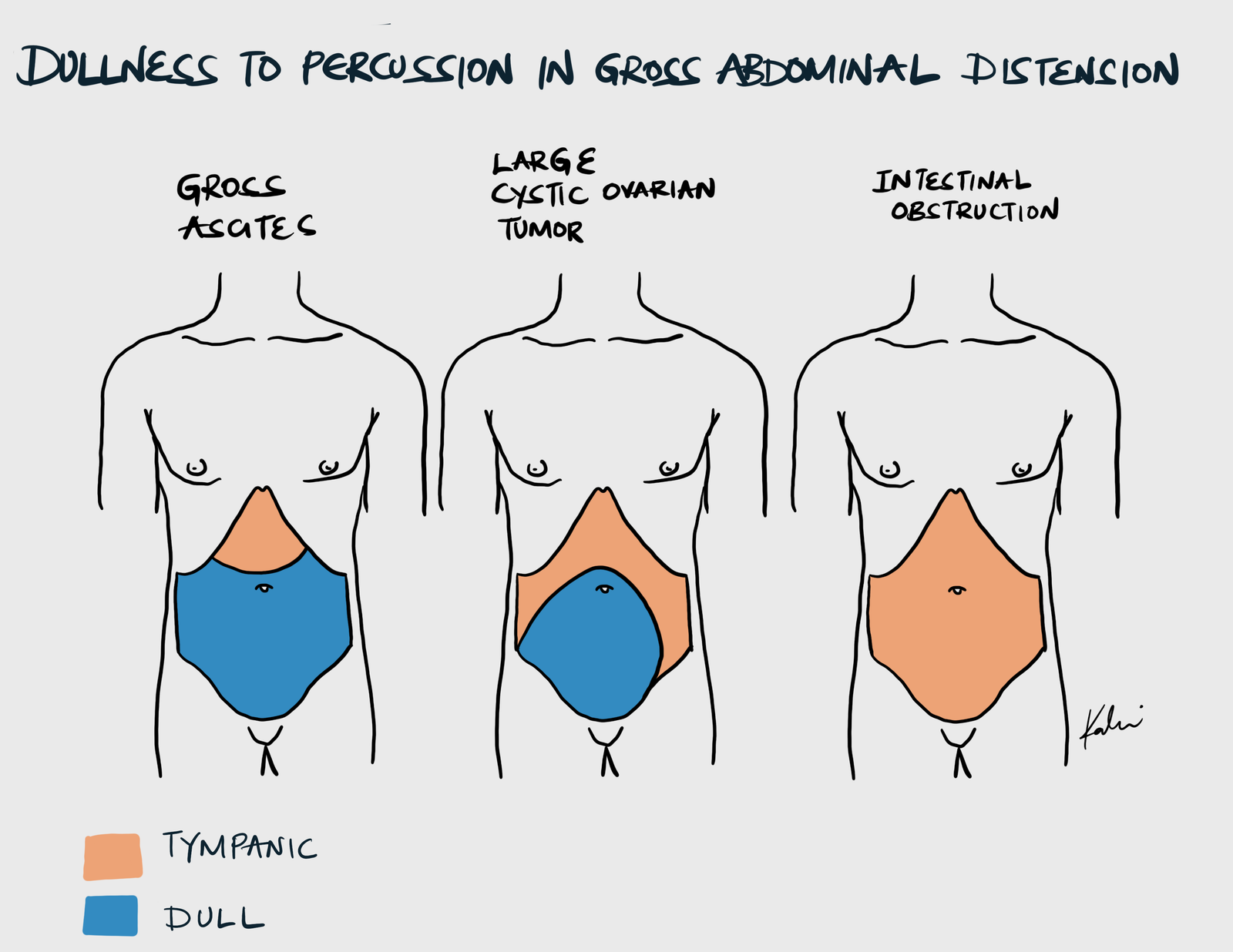 Dullness To Percussion in Abdominal Distension