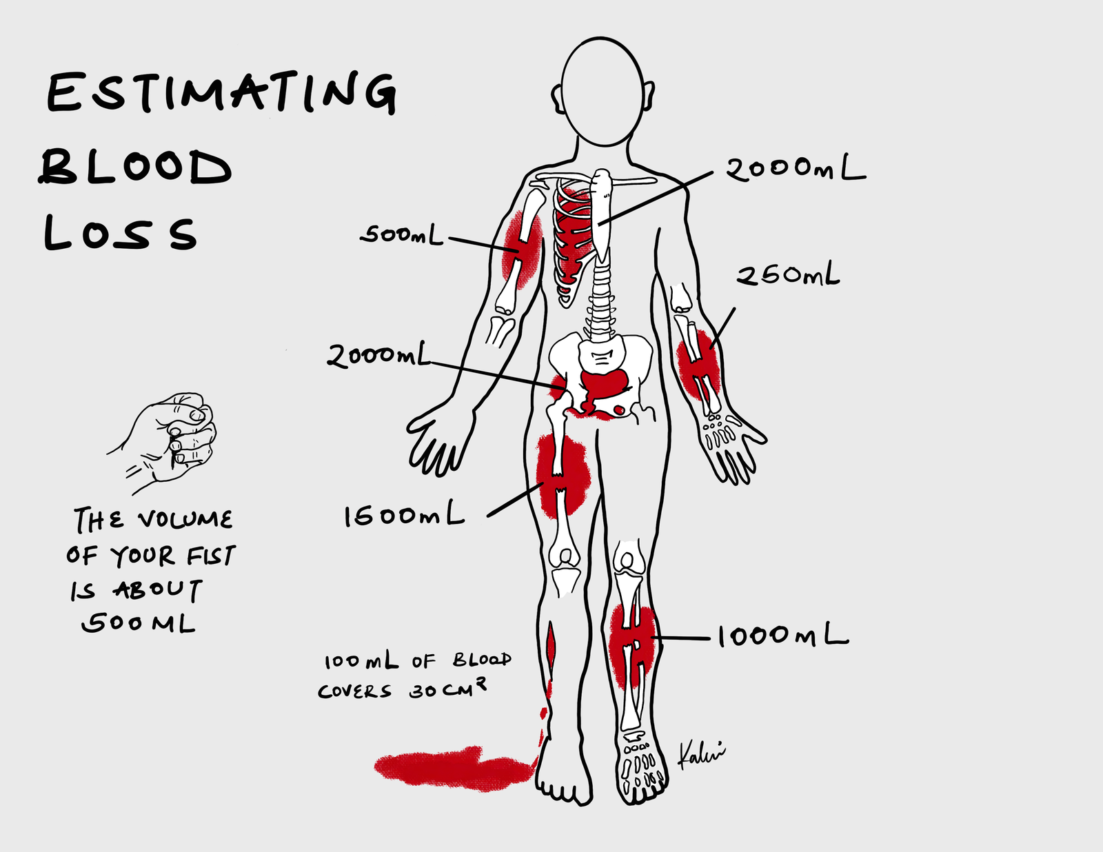 Estimating-Blood-Loss