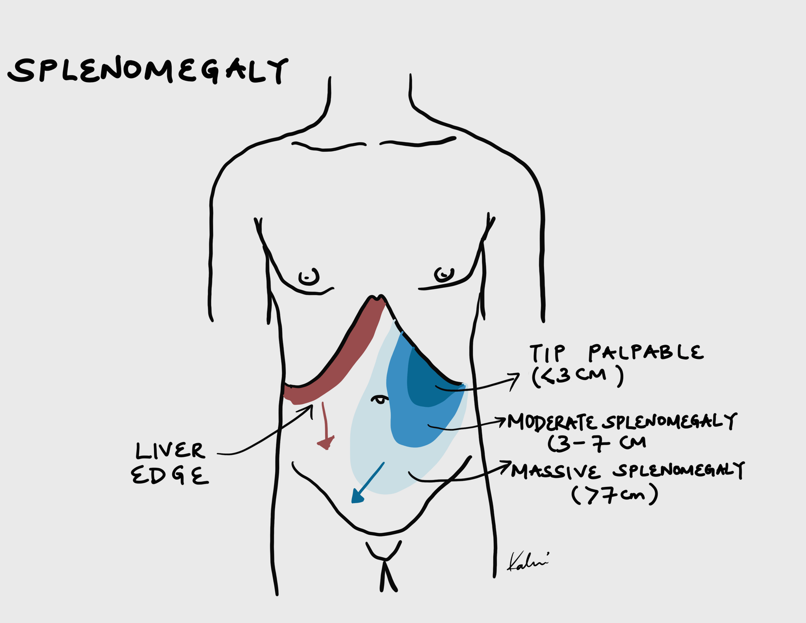 Splenomegaly