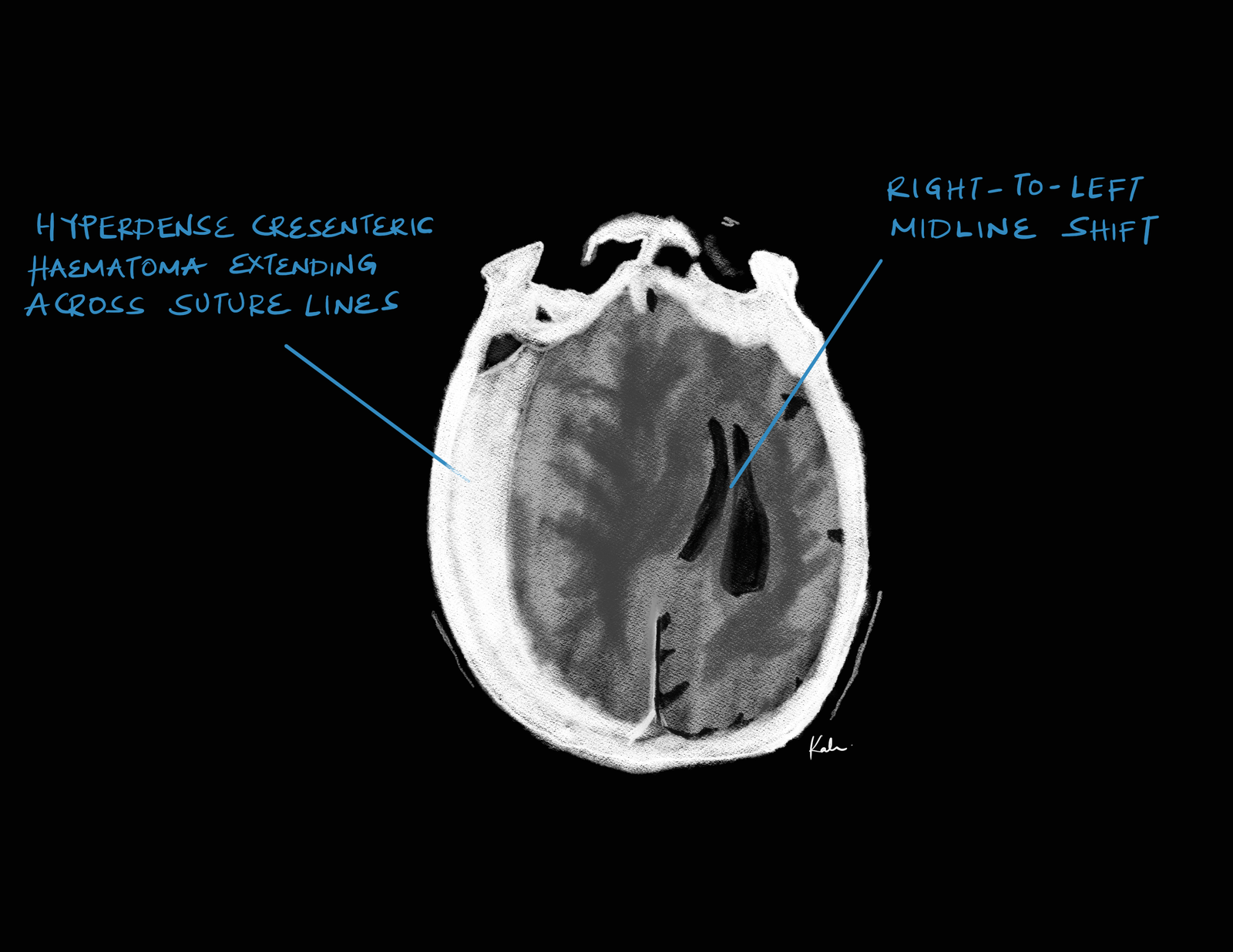 Acute subdural hematoma