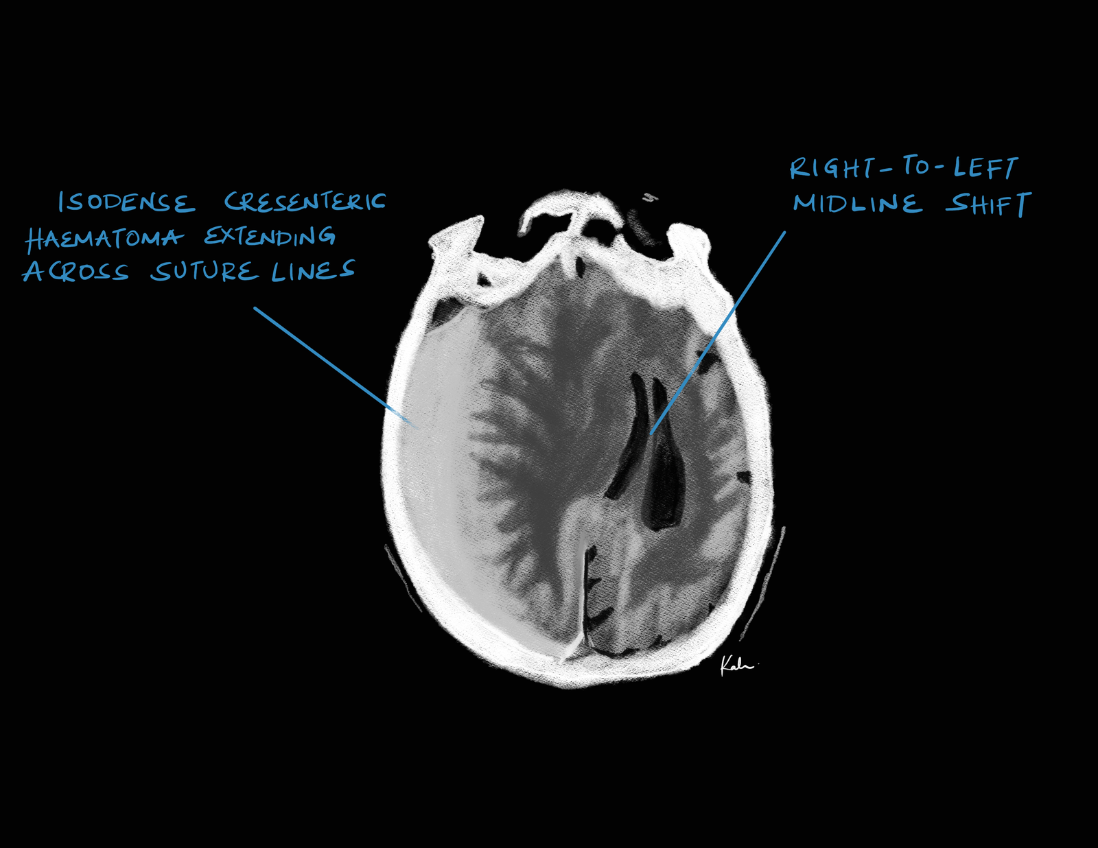 Chronic subdural hematoma
