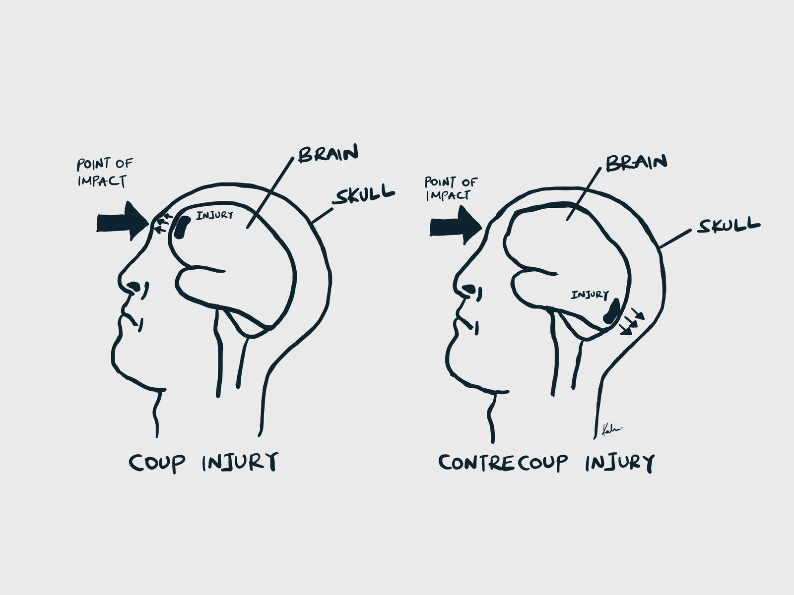 Coup vs Contrecoup injury