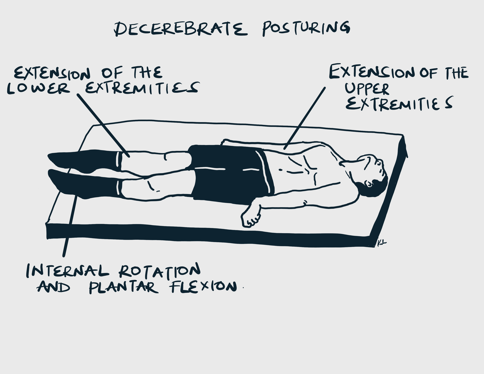 Decerebrate posturing