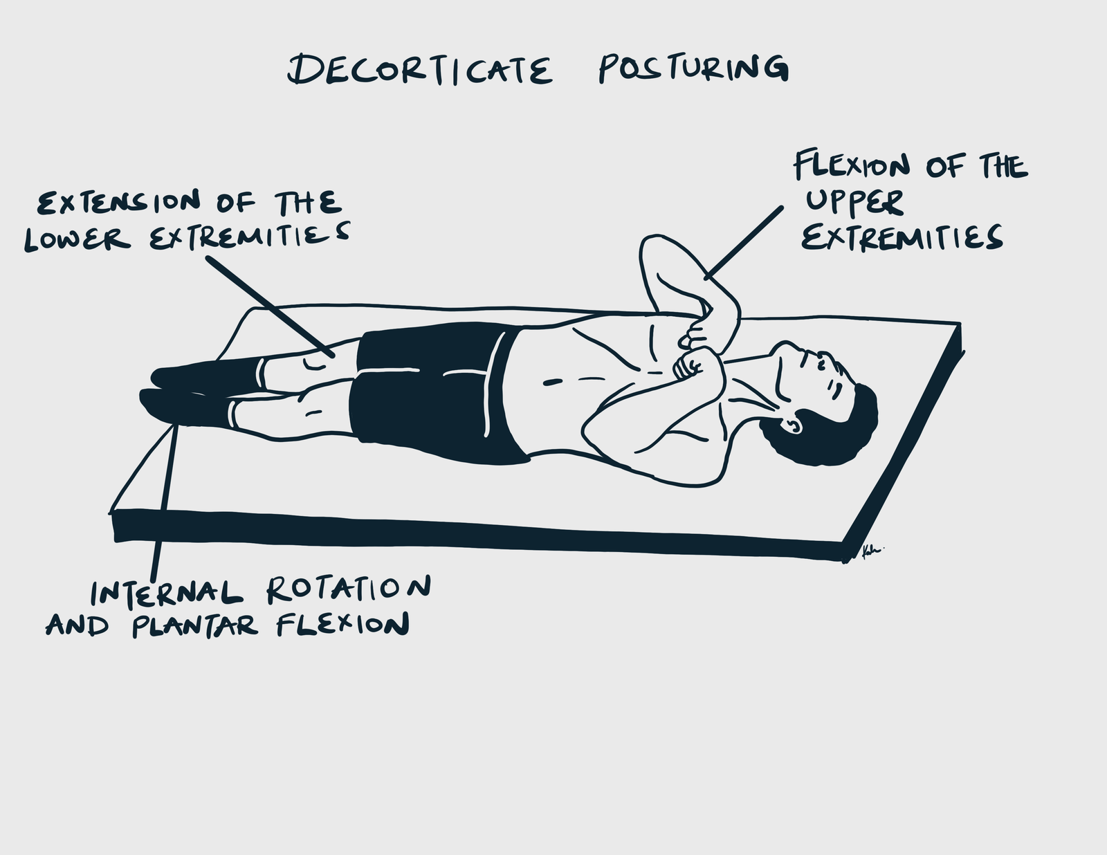 Decorticate Postruring